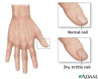 Brittle Nails
